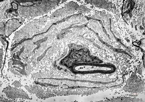 F,31y. | hypertrophic demyelinating neuropathy - n.suralis